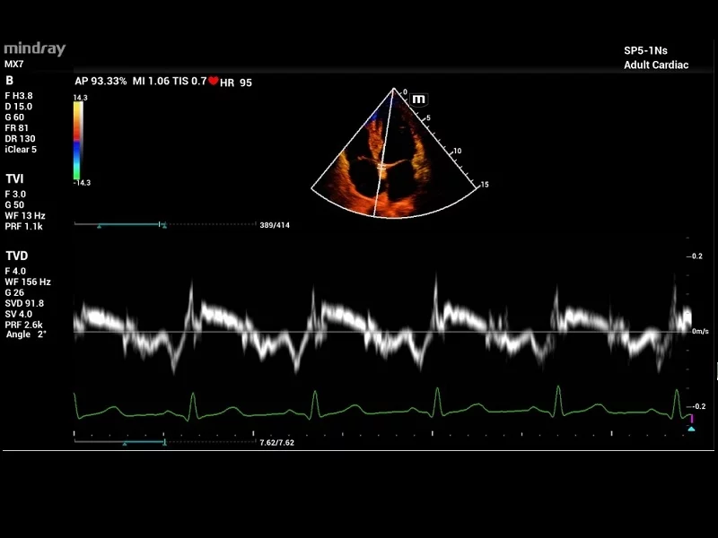 Ультразвуковой сканер Mindray MX7