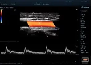 Ультразвуковой сканер Mindray Resona 6